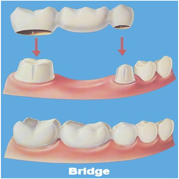 Dental Bridge