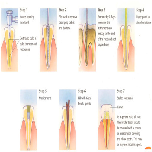 Root canal treatment
