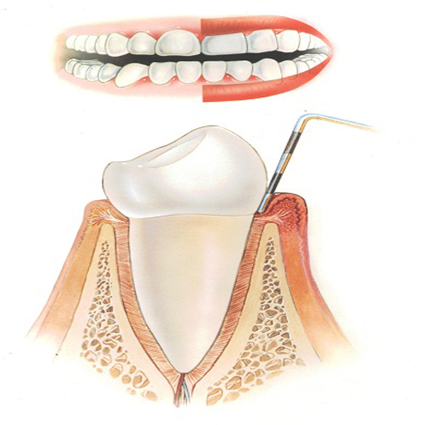 Gum Disease Periodontics