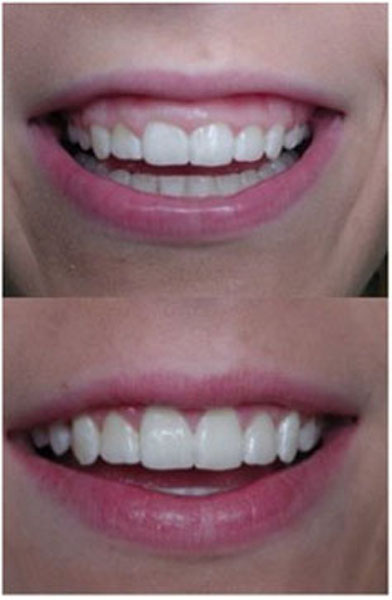 Gummy smile