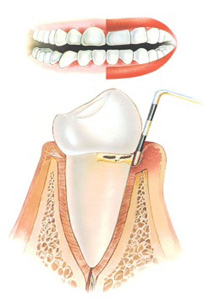 Periodontitis